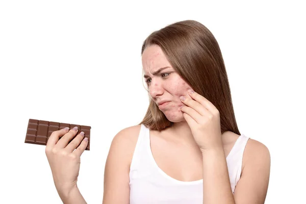Mujer Joven Con Problemas Acné Sosteniendo Barra Chocolate Sobre Fondo — Foto de Stock