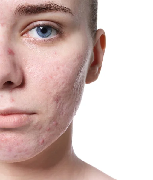 Young Woman Acne Problem White Background — Stock Photo, Image