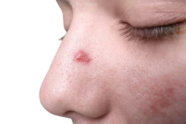 Young Woman Acne Her Face Closeup — Stock Photo, Image
