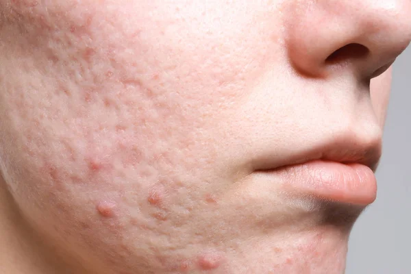 Jeune Femme Avec Acné Sur Visage Gros Plan — Photo