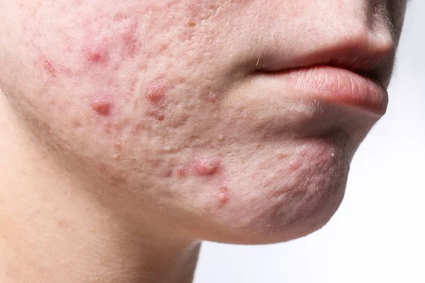 Young Woman Acne Her Face Closeup — Stock Photo, Image