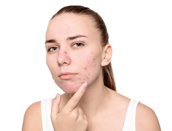 Mujer Joven Con Problemas Acné Sobre Fondo Blanco — Foto de Stock