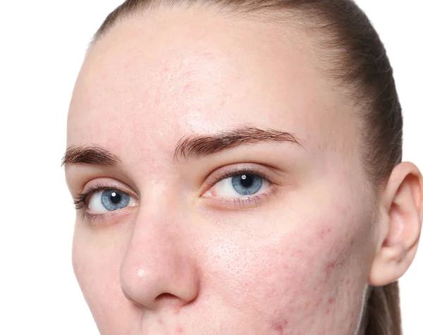 Young Woman Acne Problem White Background — Stock Photo, Image