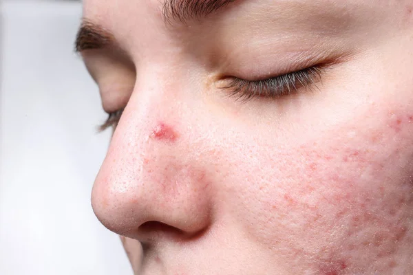 Jeune Femme Avec Acné Sur Visage Gros Plan — Photo