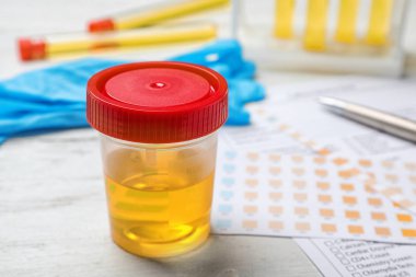 İdrar örneği tablo ile jar. Üroloji kavramı