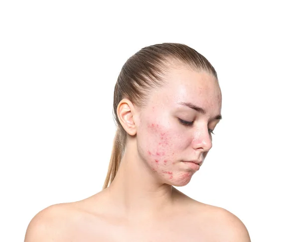 Jonge Vrouw Met Acne Probleem Witte Achtergrond — Stockfoto