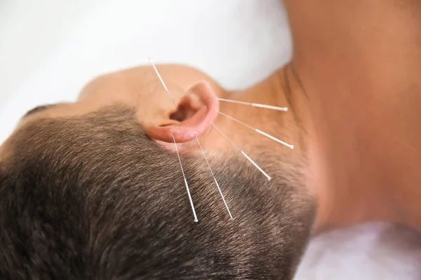 Młody Człowiek Trakcie Leczenia Akupunktura Salonie Zbliżenie — Zdjęcie stockowe