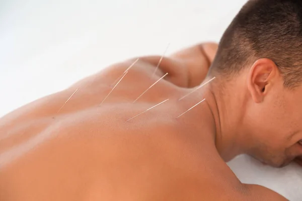 Ung Man Som Genomgår Akupunkturbehandling Salongen Närbild — Stockfoto