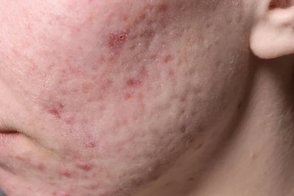 Young Woman Acne Her Face Closeup — Stock Photo, Image