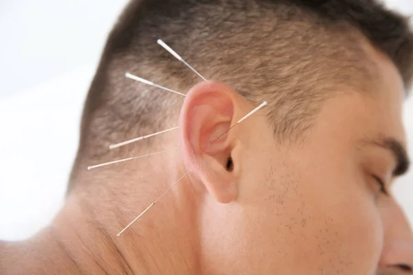 Jeune Homme Subissant Traitement Acupuncture Dans Salon Gros Plan — Photo