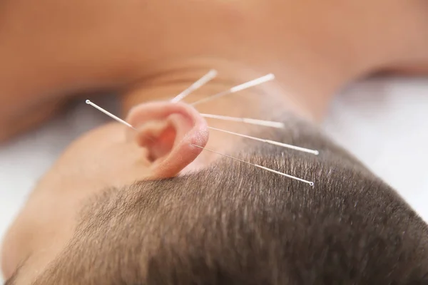 Młody Człowiek Trakcie Leczenia Akupunktura Salonie Zbliżenie — Zdjęcie stockowe