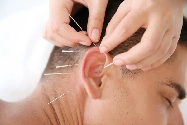 Salonda Closeup Akupunktur Tedavisi Gören Genç Adam — Stok fotoğraf