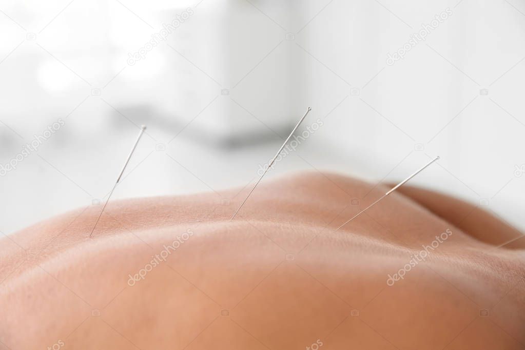 Young man undergoing acupuncture treatment in salon, closeup