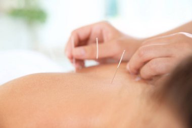 Salonda, closeup akupunktur tedavisi gören genç kadın