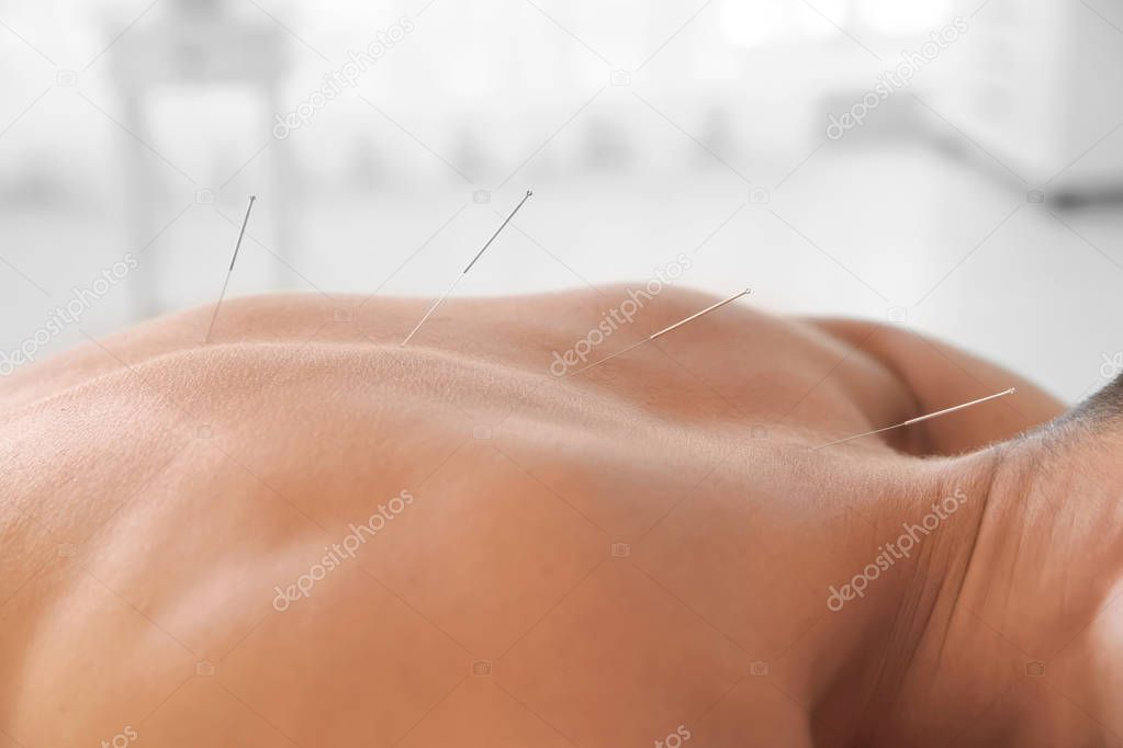 Young man undergoing acupuncture treatment in salon, closeup