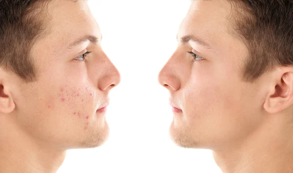 Teenager Vor Und Nach Der Akne Behandlung Auf Weißem Hintergrund — Stockfoto