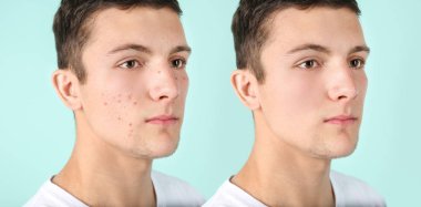 Teenager before and after acne treatment on color background. Skin care concept clipart