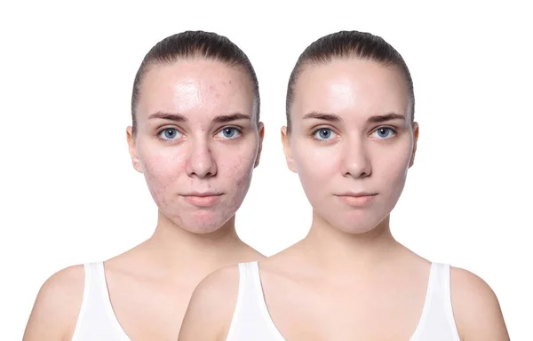 Mulher Jovem Antes Depois Tratamento Acne Fundo Branco Conceito Cuidados — Fotografia de Stock