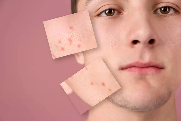 Tonåring Före Och Efter Akne Behandling Färgbakgrund Hud Vård Koncept — Stockfoto