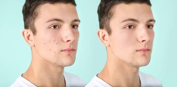 Teenager Vor Und Nach Der Akne Behandlung Auf Farbigem Hintergrund — Stockfoto