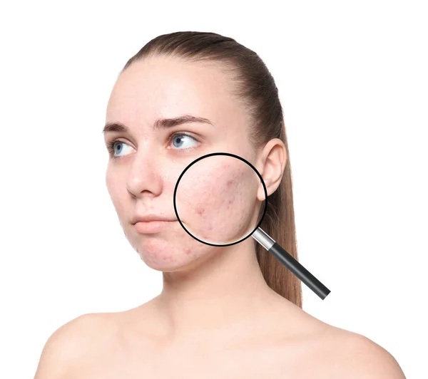 Magnifying Young Woman Skin Acne Problem White Background — Stock Photo, Image