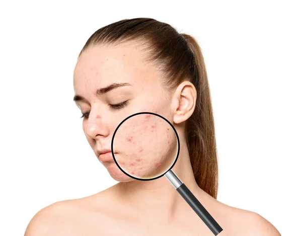 Magnifying Young Woman Skin Acne Problem White Background — Stock Photo, Image