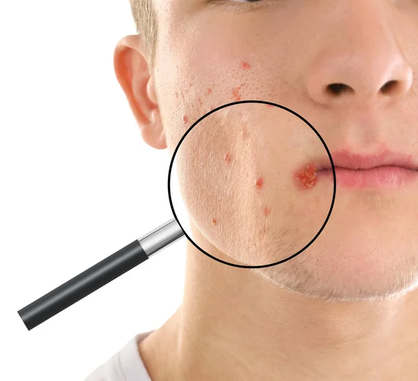 クローズ アップ ホワイト バック グラウンド上のにきび問題で若い男の皮膚を拡大 — ストック写真