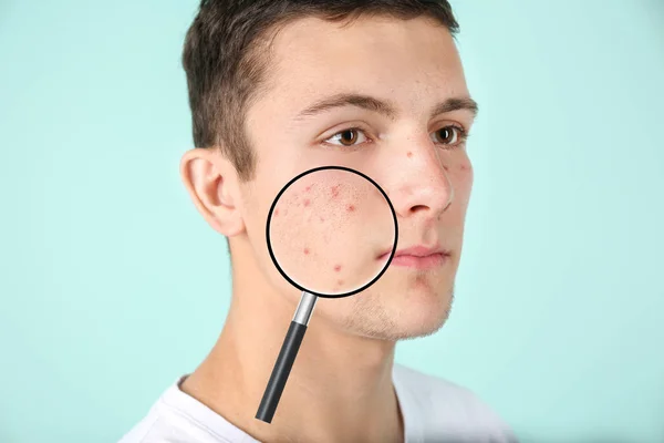 Magnifying Young Man Skin Acne Problem Color Background — Stock Photo, Image