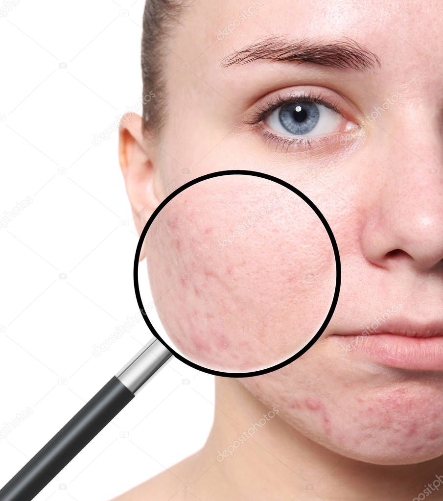 Magnifying young woman's skin with acne problem on white background