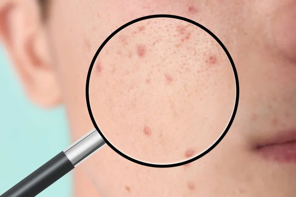 Magnifying Young Man Skin Acne Problem Closeup — Stock Photo, Image