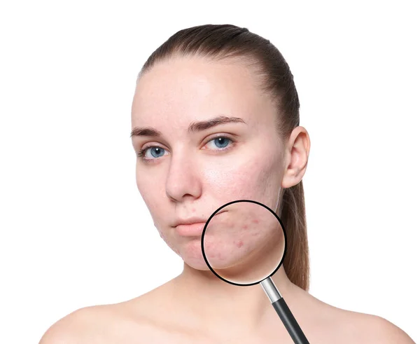 Magnifying Young Woman Skin Acne Problem White Background — Stock Photo, Image