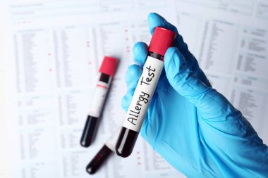 Cam tüp kan ile masa üzerinde üstten görünüm tutan doktor. Alerji testi