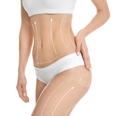 Beyaz arka plan üzerinde liposuction işlemi için işaretleri olan kadın. Kozmetik cerrahi