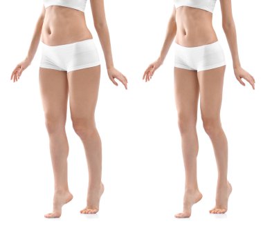 Genç kadın önce ve sonra liposuction işlemi beyaz arka plan üzerinde. Kozmetik cerrahi