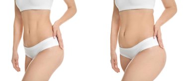 Genç kadın önce ve sonra beyaz arka plan, ön görünüm liposuction işlemi. Kozmetik cerrahi
