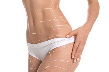 Beyaz arka plan üzerinde liposuction işlemi için işaretleri olan kadın. Kozmetik cerrahi