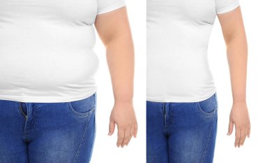 Genç kadın önce ve sonra beyaz arka plan, ön görünüm liposuction işlemi. Kozmetik cerrahi