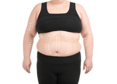 Kilolu kadın işaretleri beyaz arka plan üzerinde liposuction işlemi için. Kozmetik cerrahi