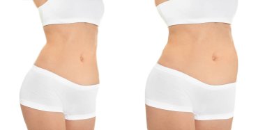 Genç kadın önce ve sonra beyaz arka plan, ön görünüm liposuction işlemi. Kozmetik cerrahi