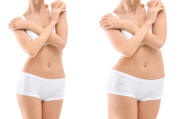 Genç Kadın Önce Sonra Beyaz Arka Plan Görünüm Liposuction Işlemi — Stok fotoğraf
