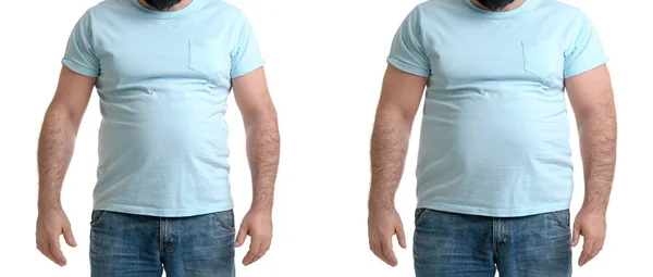 Junger Mann Vor Und Nach Der Fettabsaugung Auf Weißem Hintergrund — Stockfoto