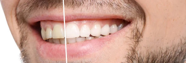 Χαμογελαστός Άνθρωπος Πριν Και Μετά Λεύκανση Δοντιών Διαδικασία Κοντινό Πλάνο — Φωτογραφία Αρχείου
