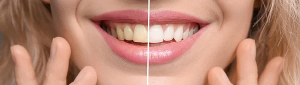 Uśmiechający Się Kobieta Przed Teeth Whitening Procedury Zbliżenie — Zdjęcie stockowe