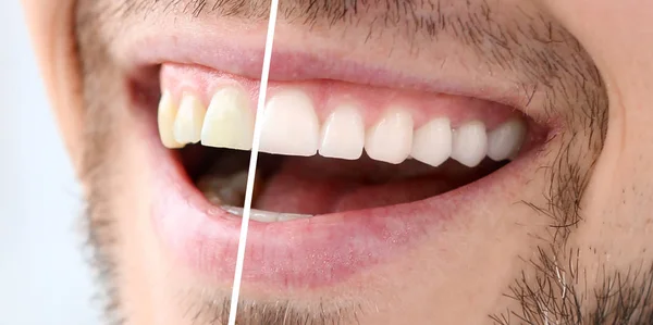 Smiling Man Teeth Whitening Procedure Closeup — Stock Photo, Image