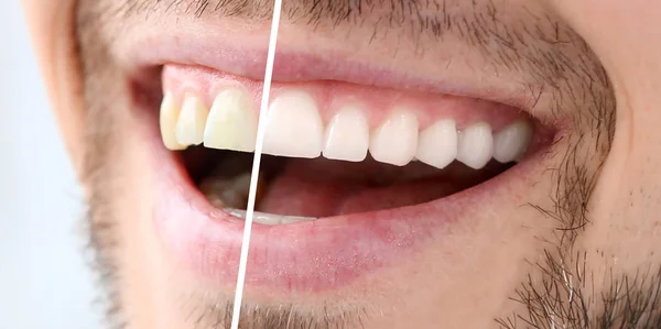 Smiling Man Giginya Whitening Procedure Closeup — Stok Foto