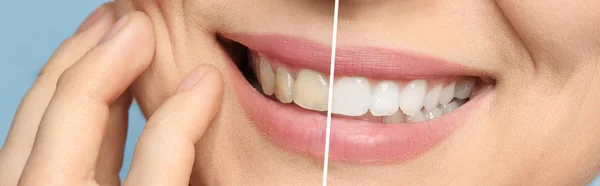 Lächelnde Frau Vor Und Nach Der Zahnaufhellung Nahaufnahme — Stockfoto