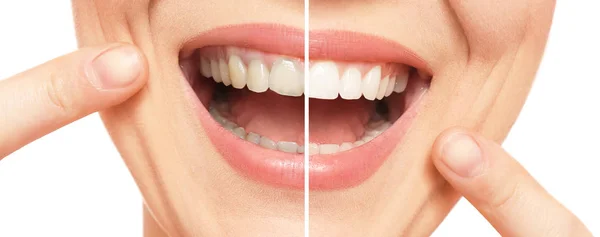 Mujer Sonriente Antes Después Del Procedimiento Blanqueamiento Dientes Primer Plano — Foto de Stock