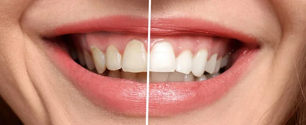 stock image Smiling woman before and after teeth whitening procedure, closeup