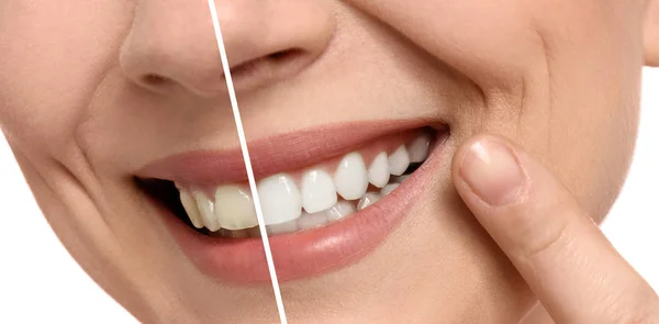 Donna Sorridente Prima Dopo Procedura Sbiancamento Dei Denti Primo Piano — Foto Stock