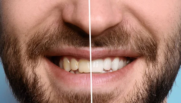 Hombre Sonriente Antes Después Del Procedimiento Blanqueamiento Dientes Primer Plano — Foto de Stock